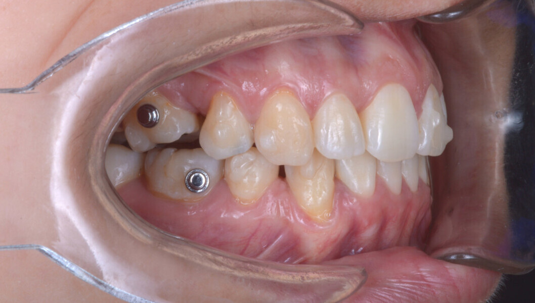 Fig. 6c: Intra-oral and occlusal photographs during treatment (after the 32nd aligner pair).