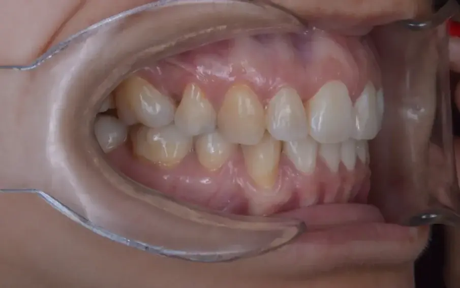 Фиг. 7c: Окончателни интраорални снимки.