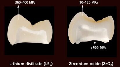 Étude : le disilicate de lithium IPS e.max est le plus matériau céramique le durable testé à ce jour