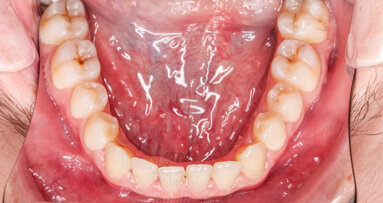 Study maps “tooth-making” mesenchymal cells on the lingual side
