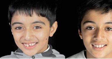 Lepljenje fragmenta i nadogradnja frakturiranog maksilarnog centralnog sekutića