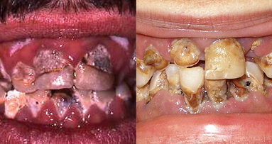 Soda and illegal drugs cause similar damage to teeth