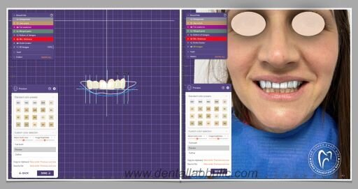 Definitivni dizajn prototipa u exocad DentalCAD softveru
