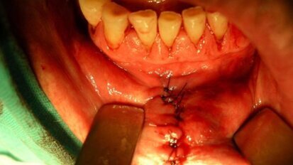 Wczesna diagnostyka i leczenie raka wargi dolnej – opis przypadku