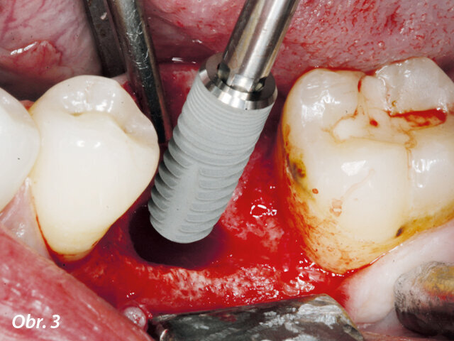 Po preparaci implantologickým motorem Implantmed byl stejným motorem našroubován implantát (průměr 4 mm, délka 12 mm) za točivého momentu 43 Ncm.