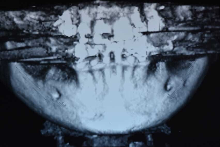Fig. 1b - CBCT iniziale.