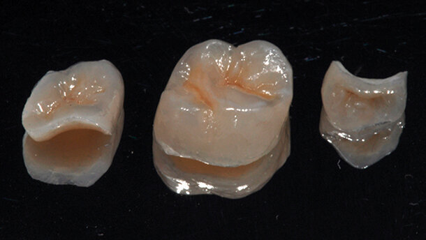 Restauri adesivi indiretti nei settori posteriori