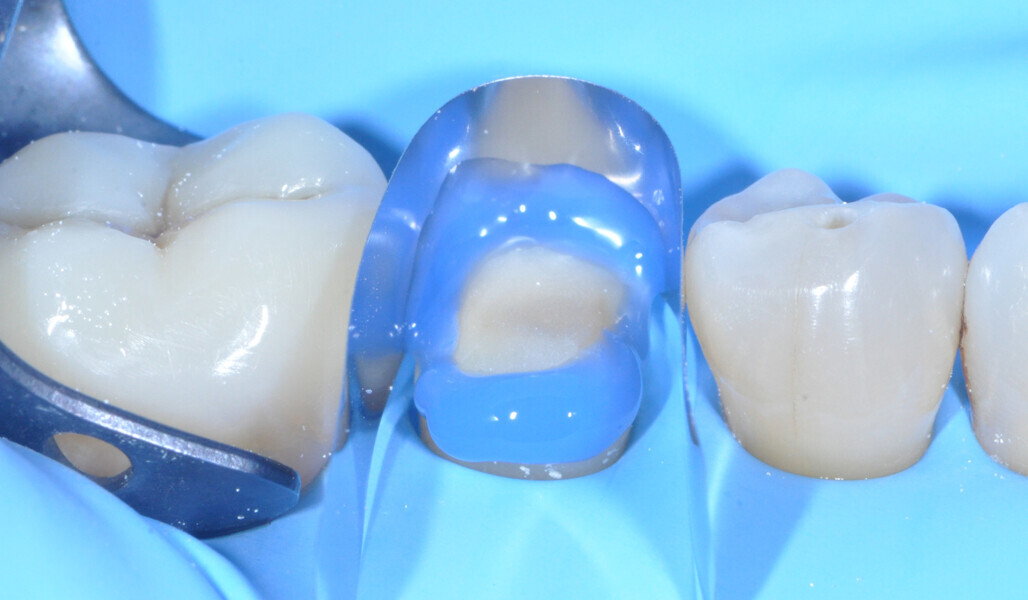 Fig. 15: Selective etching of the enamel. Adjacent teeth protected by a metal matrix strip. 