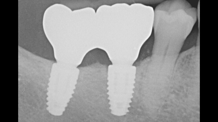 Figg. 20a, 20b_Controllo clinico e radiografico a due anni dal carico protesico.