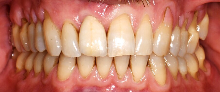 Fig.1 - Esame clinico iniziale: si noti la presenza di recessioni multiple nei 4 quadranti.