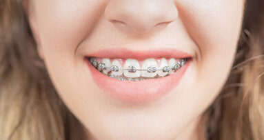 Neuer Kleber für Brackets soll vor Kariesbildung schützen