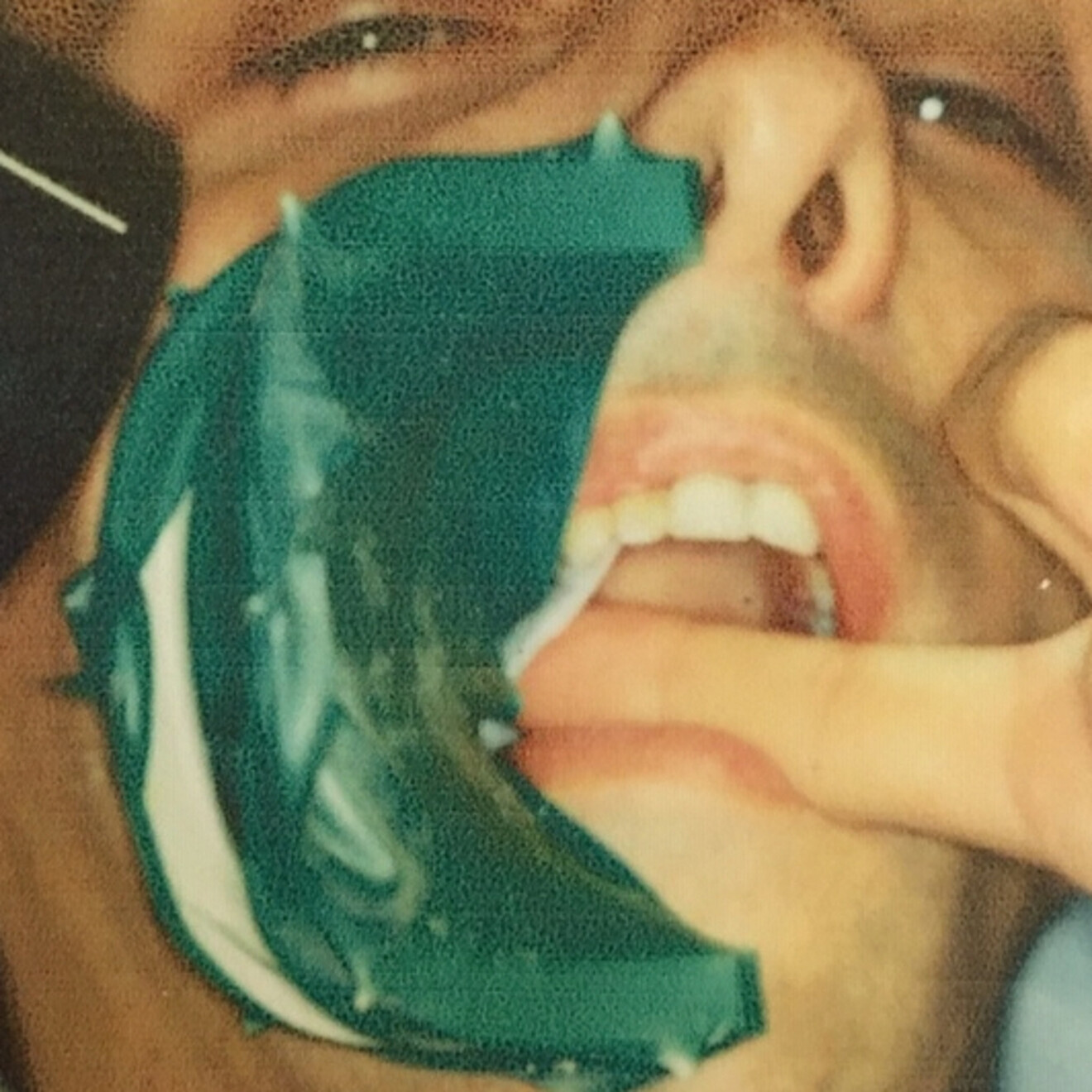 Fig. 7 : Avec le cadre articulé, la prise et le cliché radio sont facilités. 