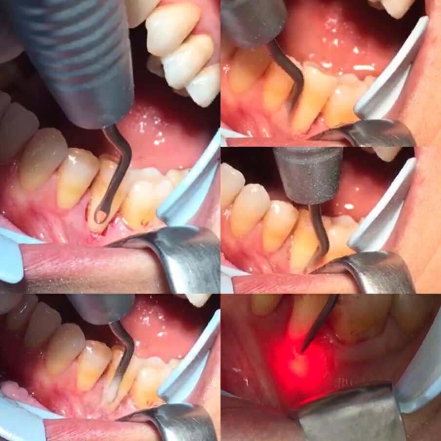 Fig. 10 - Viene mostrata la strumentazione parodontale mediante microinserti con forma ad asola con bordi arrotondati esterni non taglienti. È possibile un trattamento minimamente invasivo a cielo chiuso. L’utilizzo del laser a diodi con lunghezza d’onda di 915 nm con fibre ottiche da 400 µm svolge un’azione sinergica completando la decontaminazione del sito e stabilizzando il coagulo, presupposto per la rigenerazione parodontale.