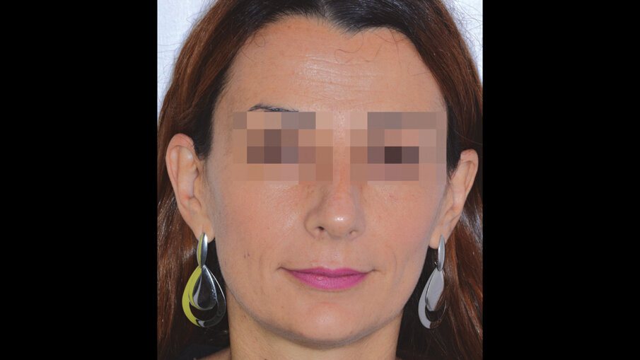 Figg. 4a-4c_Foto extraorali di inizio trattamento.