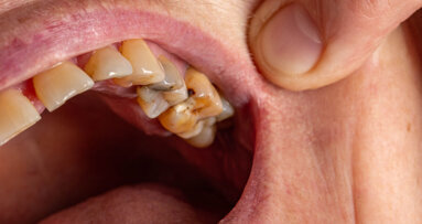 New guide offers refresher on caries treatment and pulp capping
