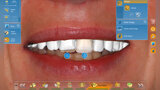 Fig. 8. La aplicación CEREC-Smile Design permite evaluar las restauraciones junto con los labios.