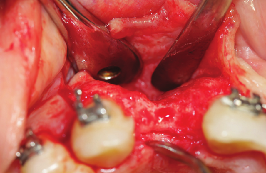 Figure 25: 3 months post-operative intervention, showing extended bone loss in the area.