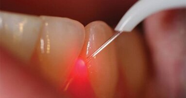 Na ogen nu ook tanden laseren