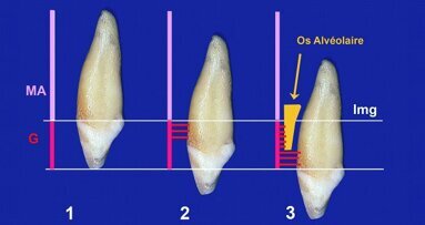 La canine incluse Désinclusion et parodonte