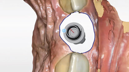 Management měkkých periimplantátových tkání pomocí kolagenní matrix a digitálního postupu