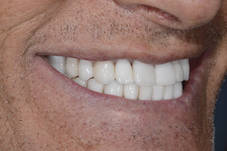 Fig. 27d: Right view of the patient’s final smile.