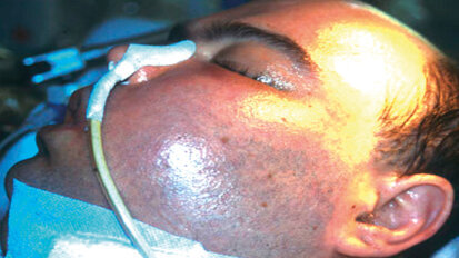 Le infezioni post-operatorie nella chirurgia odontoiatrica