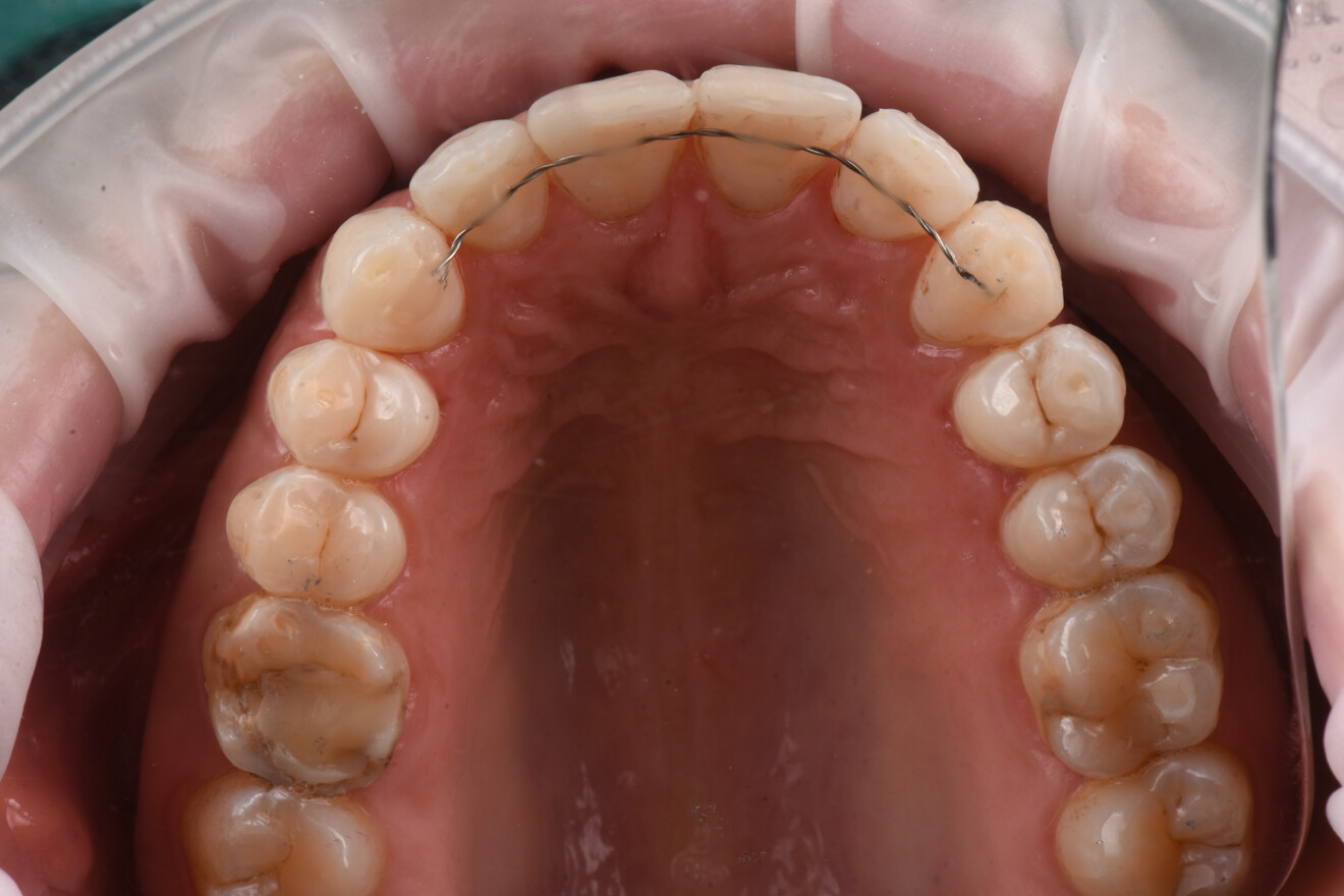 Figg. 12, 13 - Risultato finale arcata superiore e inferiore.