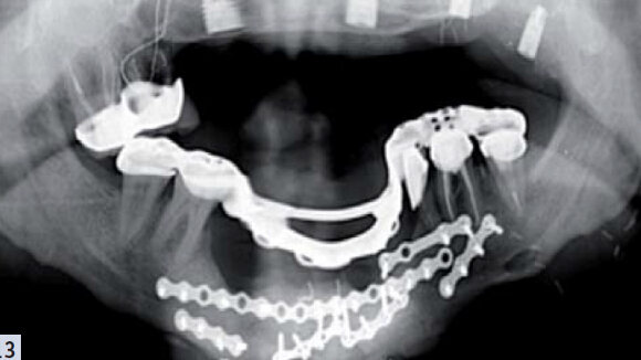 ADF 2015 : Implants et prothèse amovible partielle, un mariage de raison ?