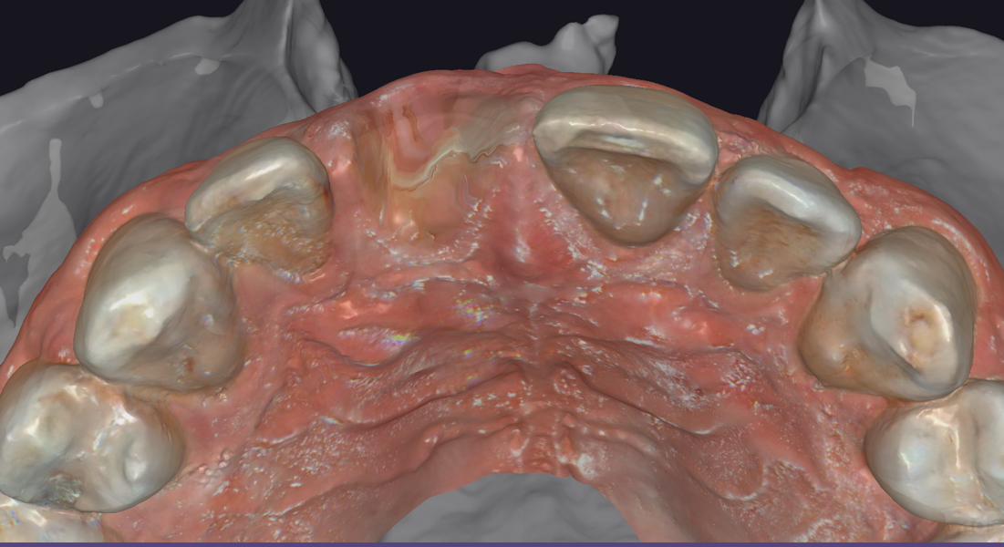 Fig. 7: Intra-oral image of the crowns adjacent to the extraction site in exoplan, occlusal view. 