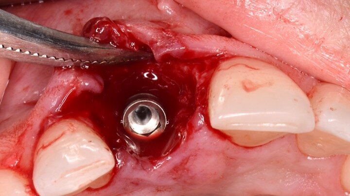 Figura 7. Implante de conexión interna insertado 2 mm por debajo de la cresta ósea, independientemente del defecto existente y a 55 Nw. Al no existir margen vestibular, tomamos como referencia los dos picos óseos de las papilas y entre ellos trazamos una línea imaginaria que los una enterrando el hombro unos 2 ó 3 mm por debajo de ella.