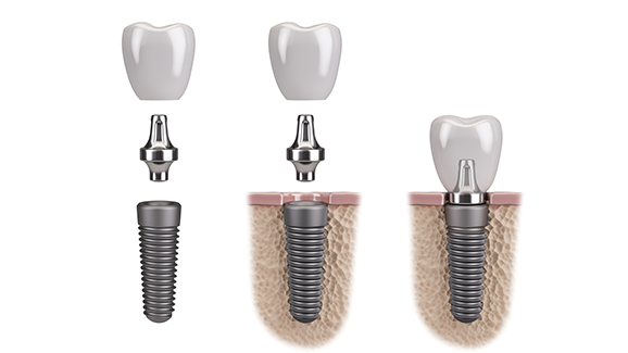 Zahnersatz als Allergieauslöser