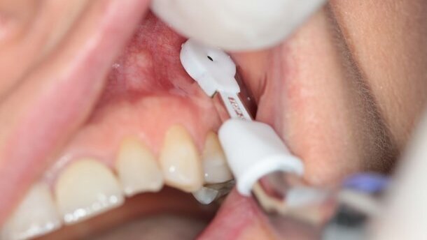 Usunięcie złamanego narzędzia endodontycznego wbitego w kości szczęki – opis przypadku