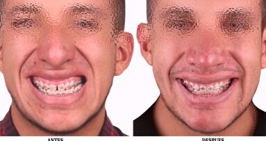 El láser en Ortodoncia (12)