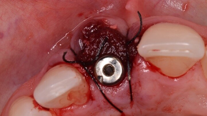 Figura 11. Podemos observar el volumen conseguido en los tejidos blandos por lo que “no” intentaremos obtener un cierre primario de la herida. Tampoco usamos membranas de larga duración, que son mucho más difíciles de moldear en dientes unitarios. Únicamente utilizamos membranas de colágeno que se adaptan perfectamente al coágulo y suturamos.

NUNCA INSERTO MEMBRANAS NI DE LARGA NI DE CORTA DURACION ENTRE EL MATERIAL Y EL PERIOSTIO. Dejamos siempre que el particulado esté en contacto directo con el periostio, de tal forma que las partículas se incorporan tanto al tejido duro como al blando.
