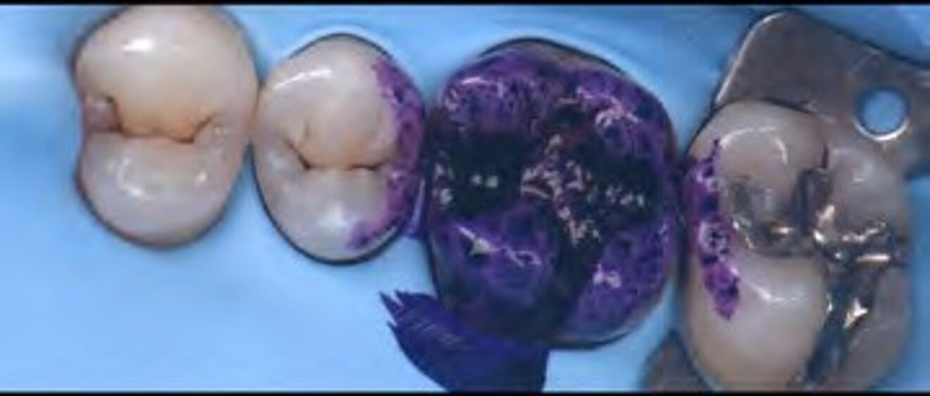 Fig. 2a: Isolation with rubber dam followed by removal of the existing defective restoration and carious tooth structure. 