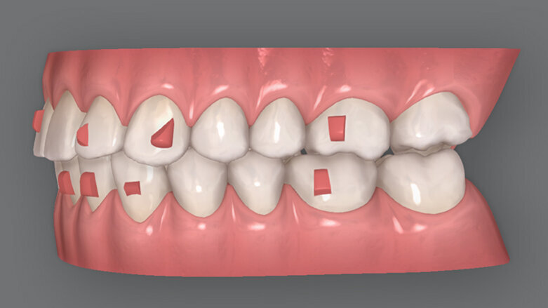 Důležitost plánování léčby a spolupráce pacienta u ortodontické techniky fóliových aparátů