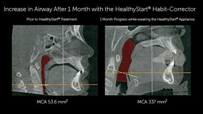 HealthyStart, a comprehensive pediatric airway system, offers online training