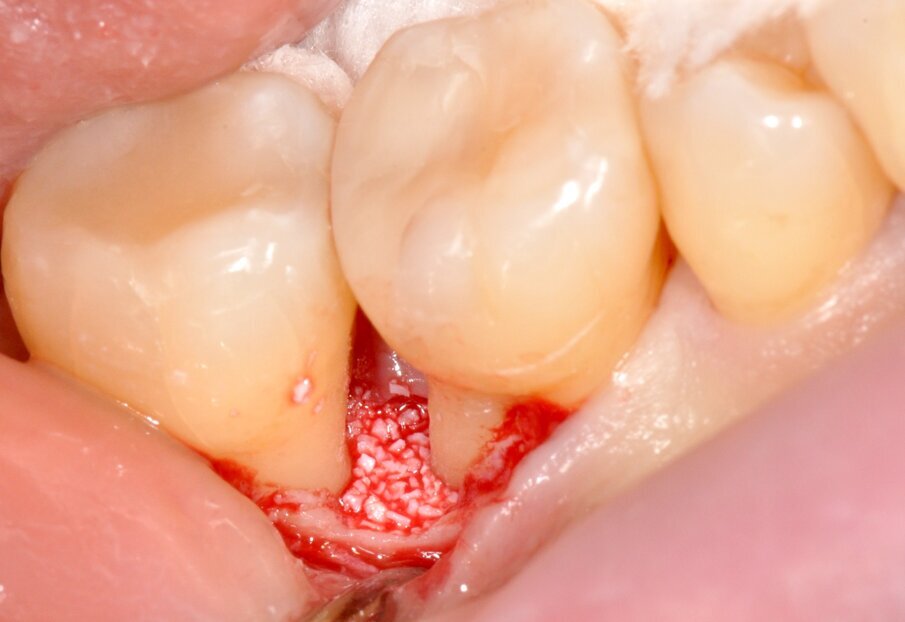 Fig. 11 - Utilizzo di Bio-Oss® per la stabilizzazione del coagulo.