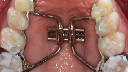 Effetto dell’Ibuprofene nella gestione del dolore  in pazienti sottoposti a espansione rapida del palato