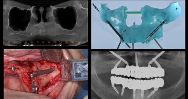 Rehabilitación del maxilar con implantes cigomáticos en paciente de edad avanzada