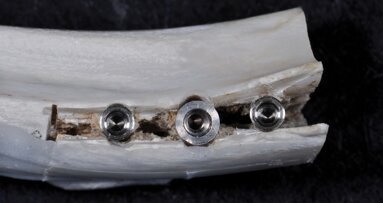 Intérêt de l’implant Fratex en présence de crêtes fines