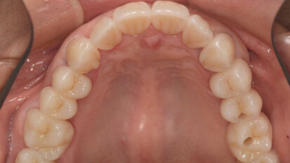 Encore un peu plus près de la nature : concepts occlusaux et esthétique raffinée en dentisterie numérique