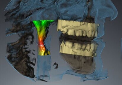 SICAT Air and OPTISLEEP