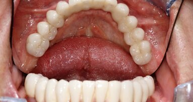 Natychmiastowa implantacja i zaopatrzenie protetyczne pacjentów z zaawansowaną chorobą przyzębia