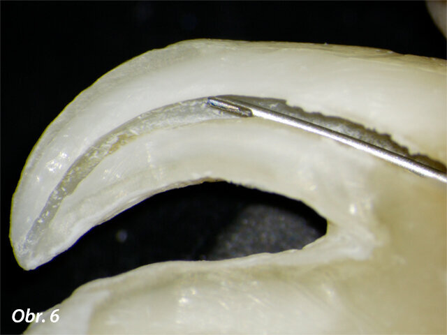 Ocelové jehly se mohou zablokovat o externí stěny kanálku, což snižuje efektivitu výplachu