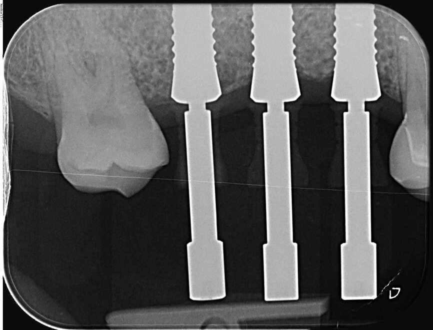 Fig. 20 : Radiographie de contrôle.