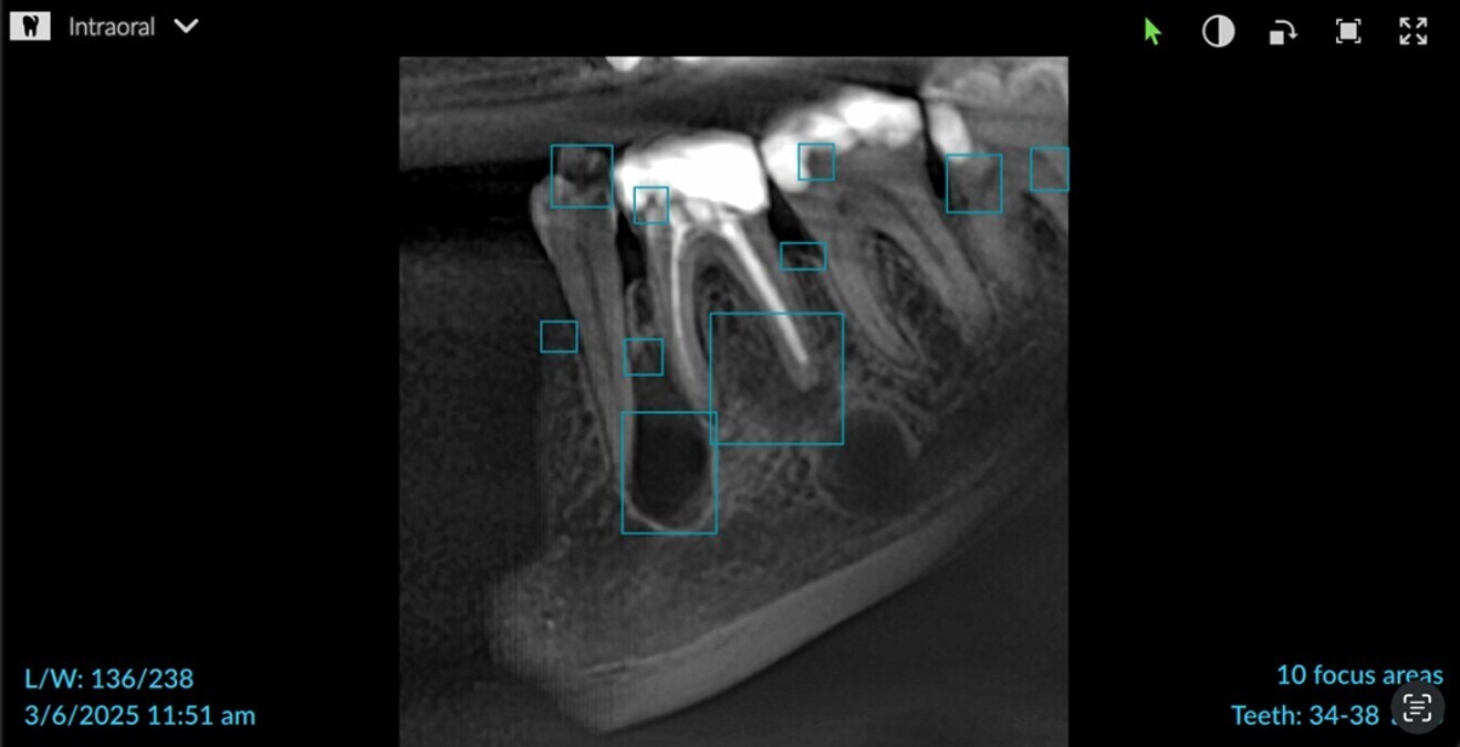 Fig. 2: Application of artificial intelligence to the 2D radiograph to focus on multiple areas in DTX Studio Clinic.