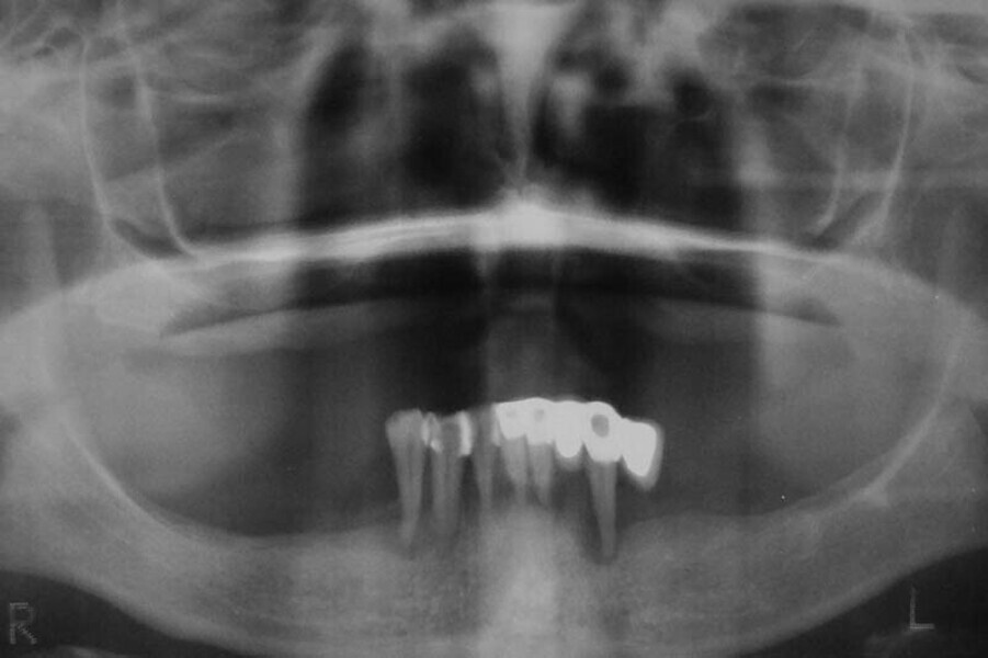Fig. 7. Rx Pre-operatoria, Prótesis híbrida inmediata con 10 años de evolución y Rx Control a los 10 años.