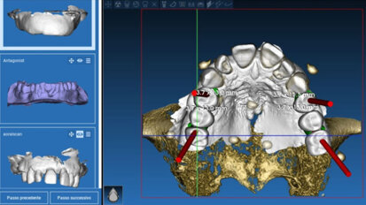 Implantologia guidata con flusso digitale completo in house