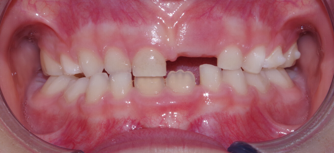 Fig. 15: Frontal intra-oral photograph at the end of treatment.